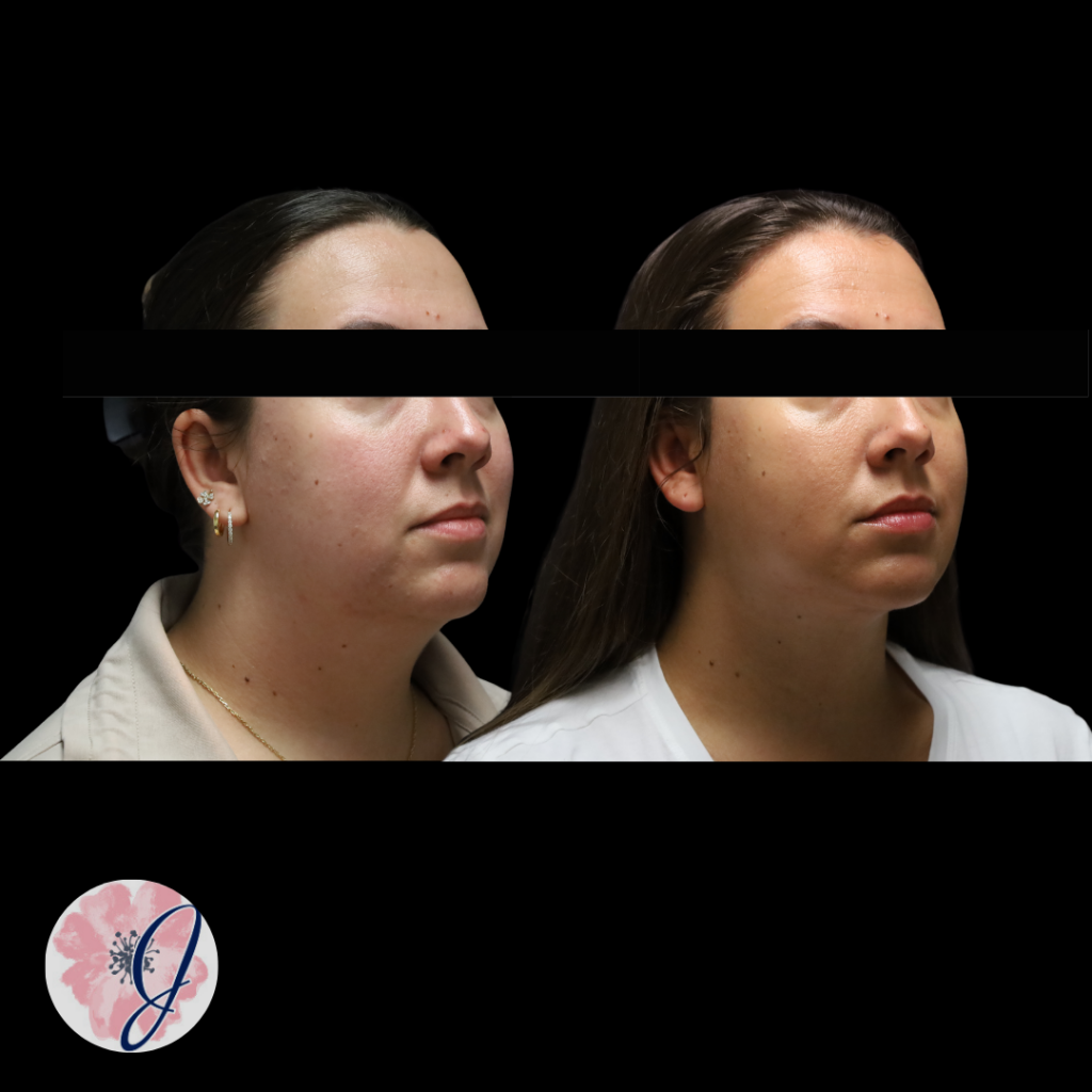 Neck Contouring: VASER Liposuction + Renuvion® + Platysmaplasty