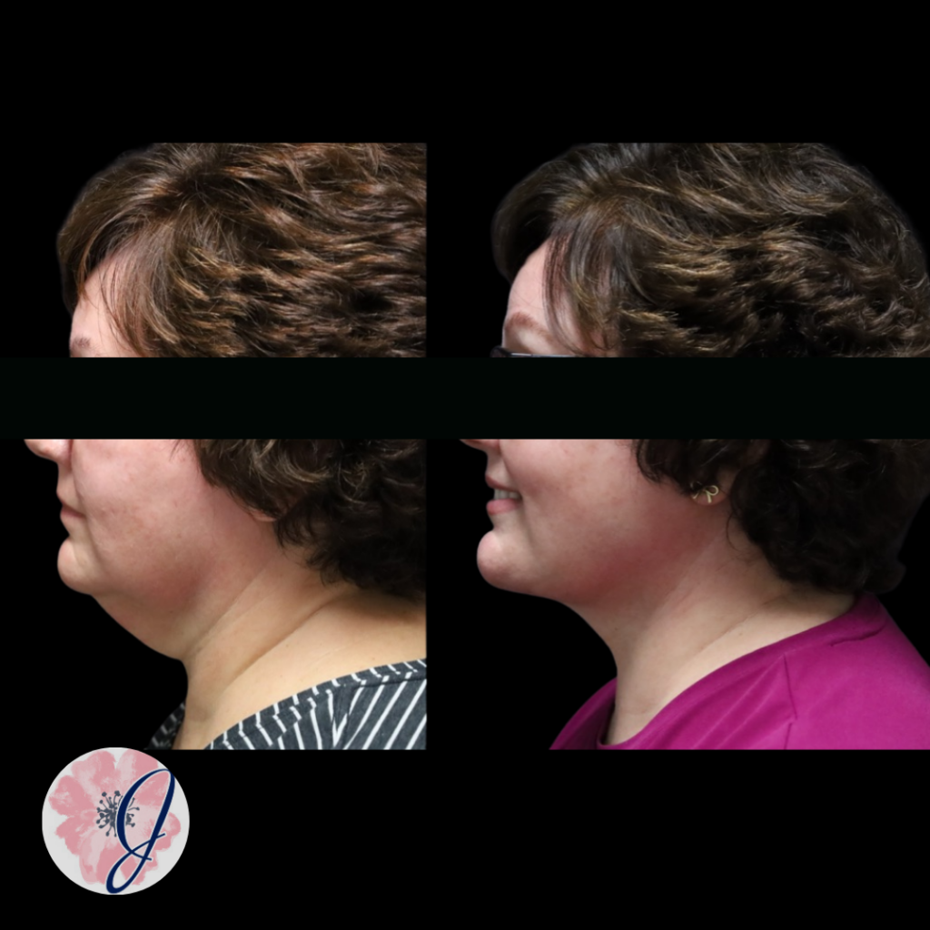 Deep Plane Neck Lift + VASER Liposuction to the Neck