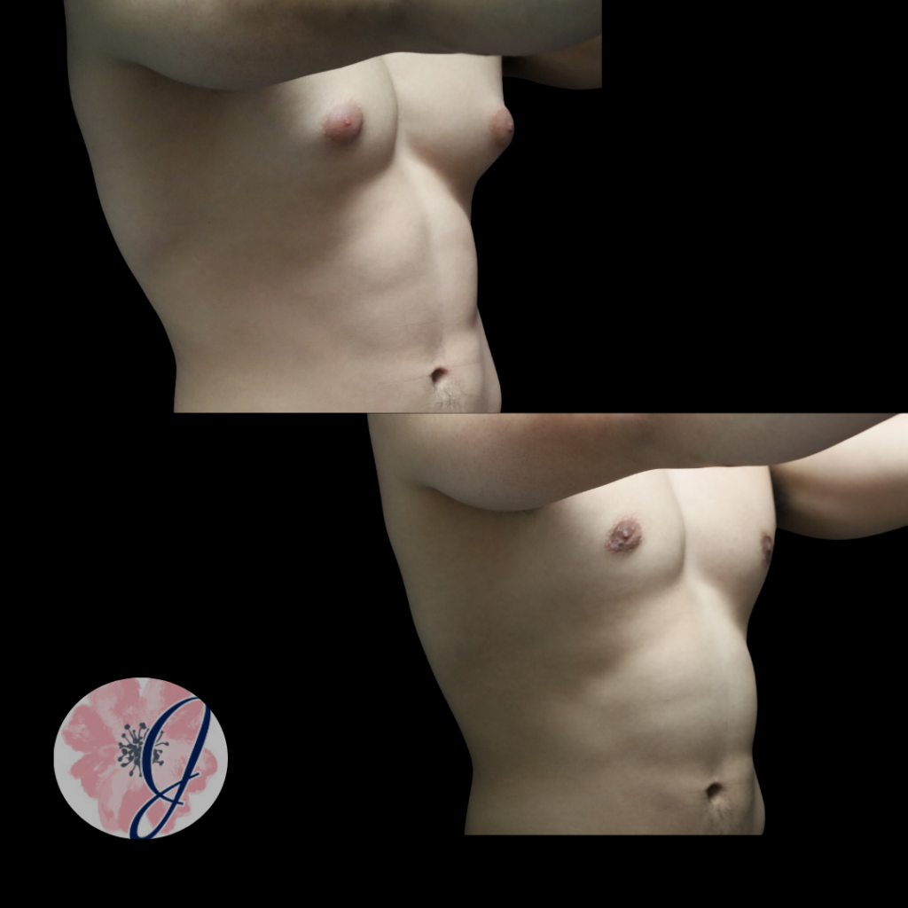 Gynecomastia (Male Breast Tissue) Removal + VASER Lipo to Chest