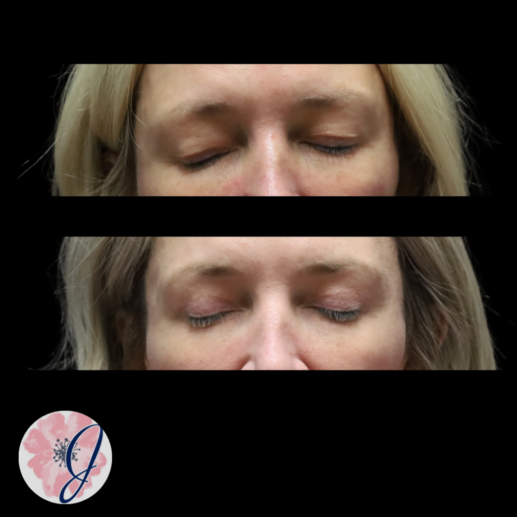 Upper Blepharoplasty (In-Office)