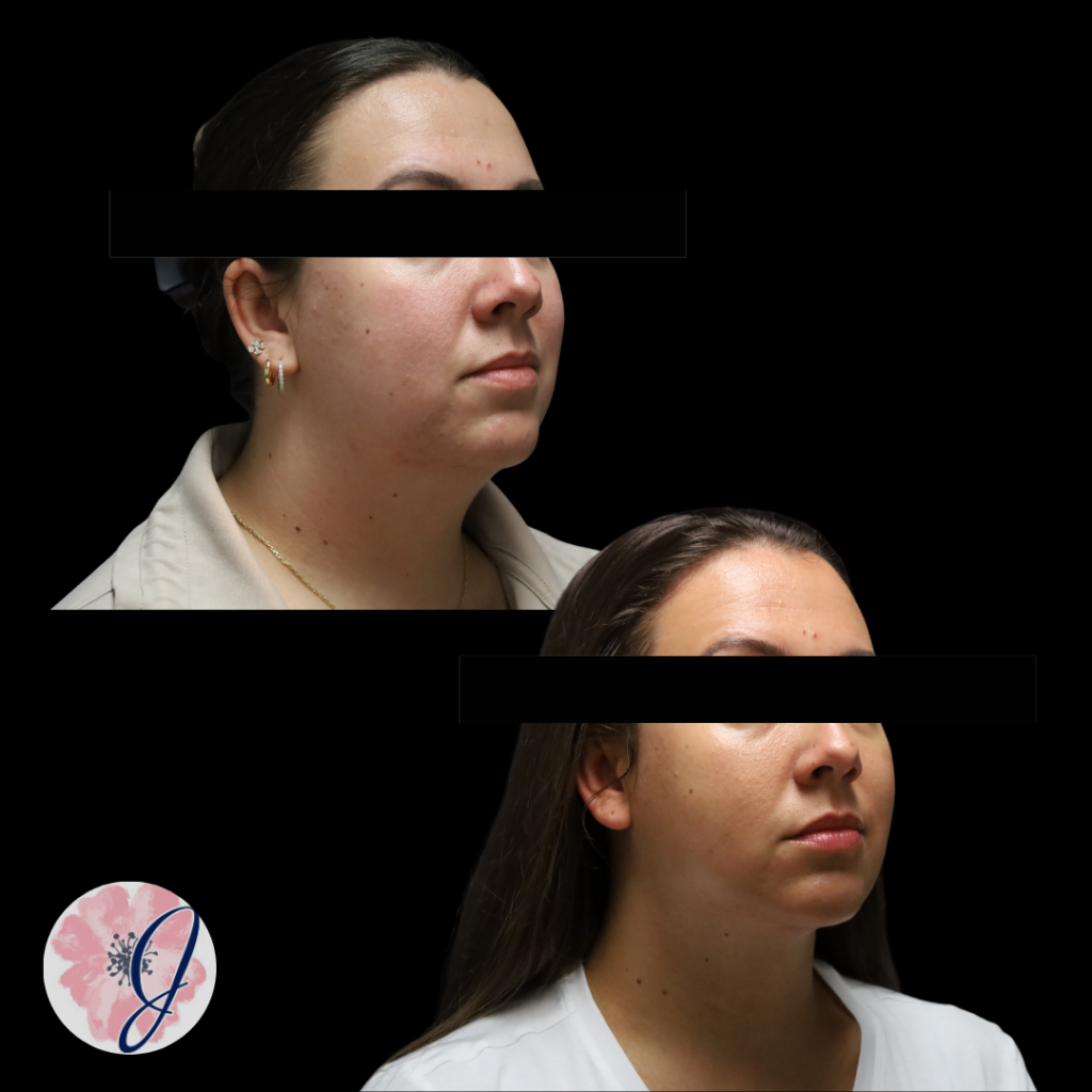 Neck Contouring: VASER Liposuction + Renuvion® + Platysmaplasty