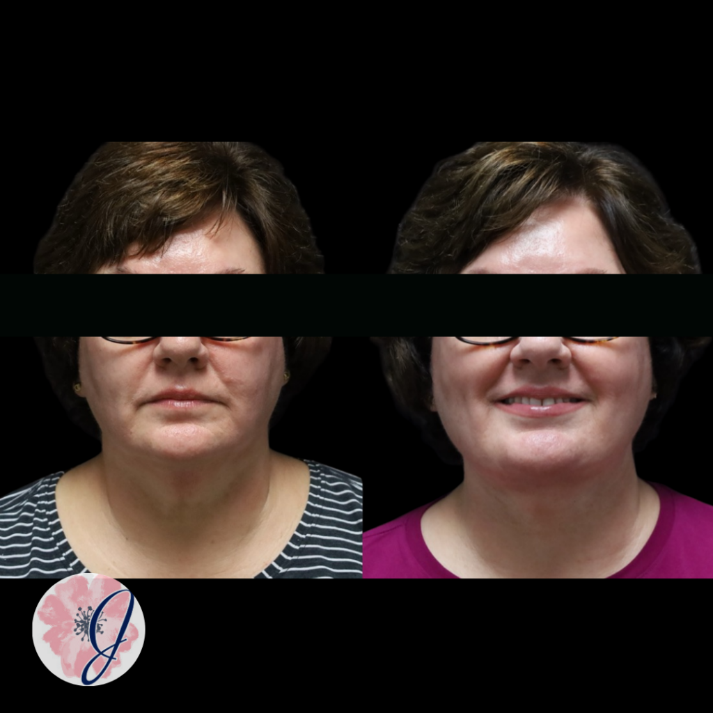 Deep Plane Neck Lift + VASER Liposuction to the Neck