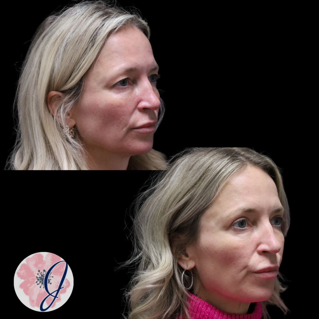 Upper Blepharoplasty (In-Office)