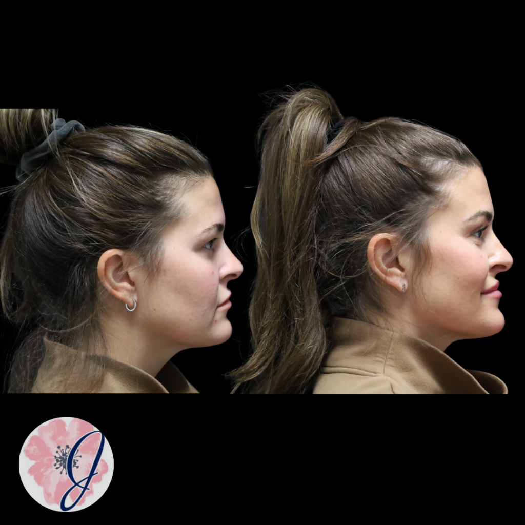 Upper Blepharoplasty (In-Office)