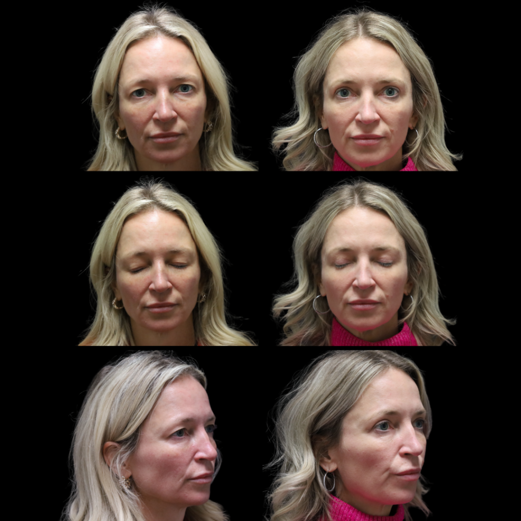 Upper Blepharoplasty (In-Office)