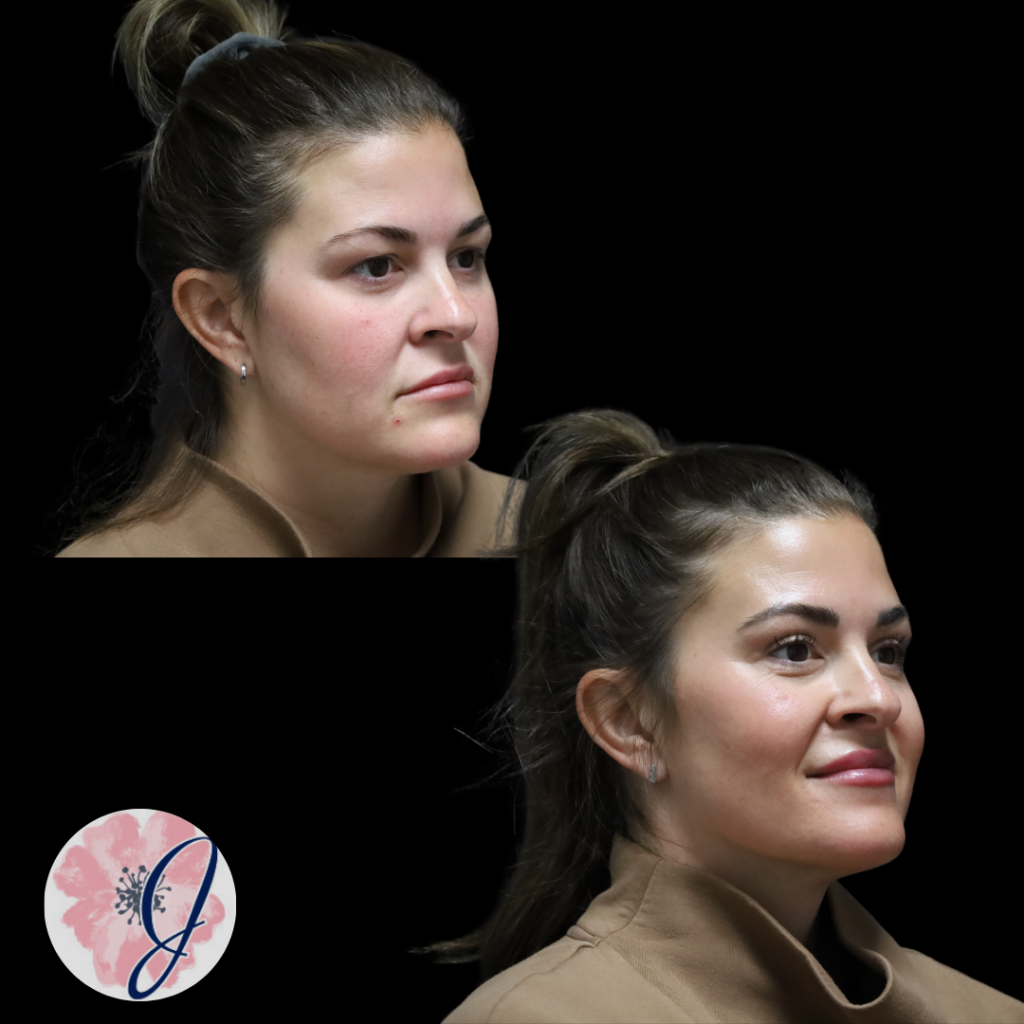 Upper Blepharoplasty (In-Office)