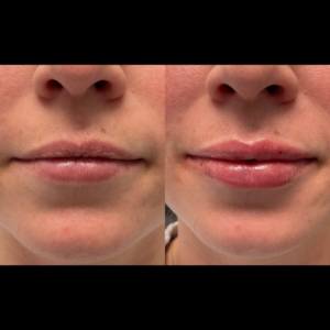 1mL Volbella To Lips