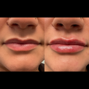 1mL Juvederm Ultra To Lips