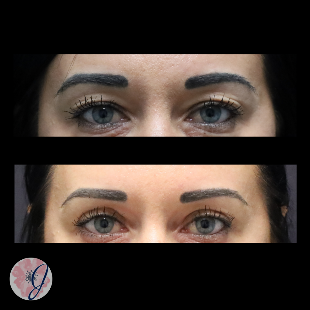 Upper Blepharoplasty (In-Office)