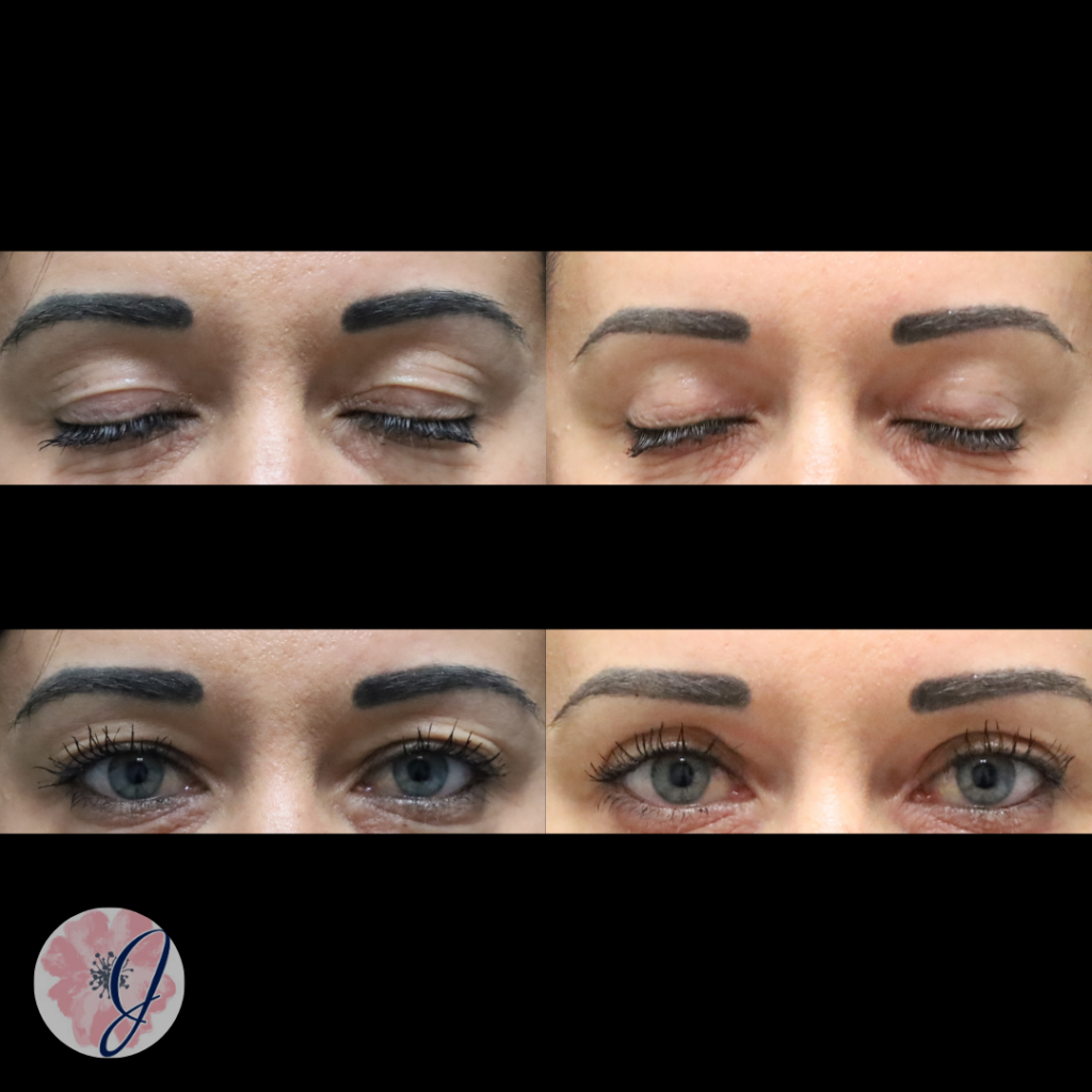 Upper Blepharoplasty (In-Office)