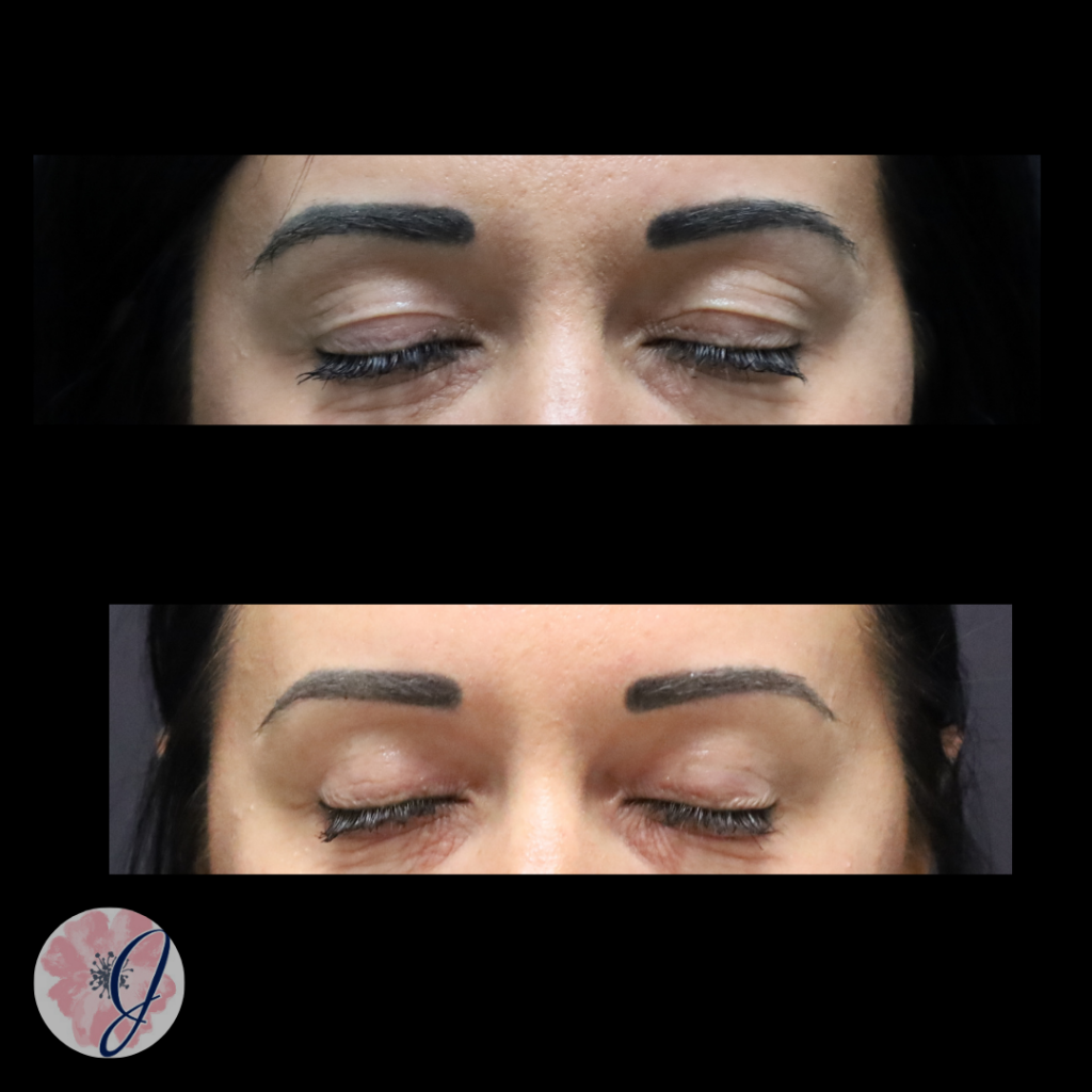 Upper Blepharoplasty (In-Office)