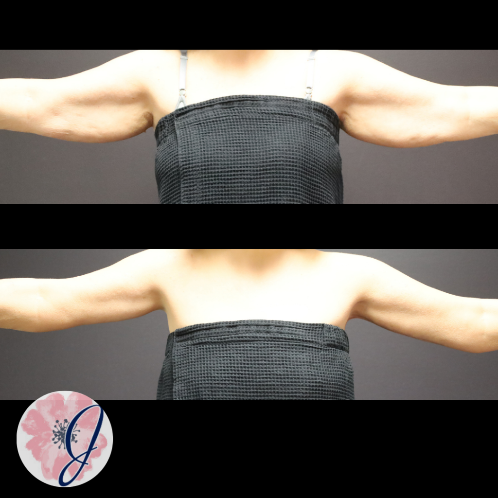 Brachioplasty + VASER liposuction to arms