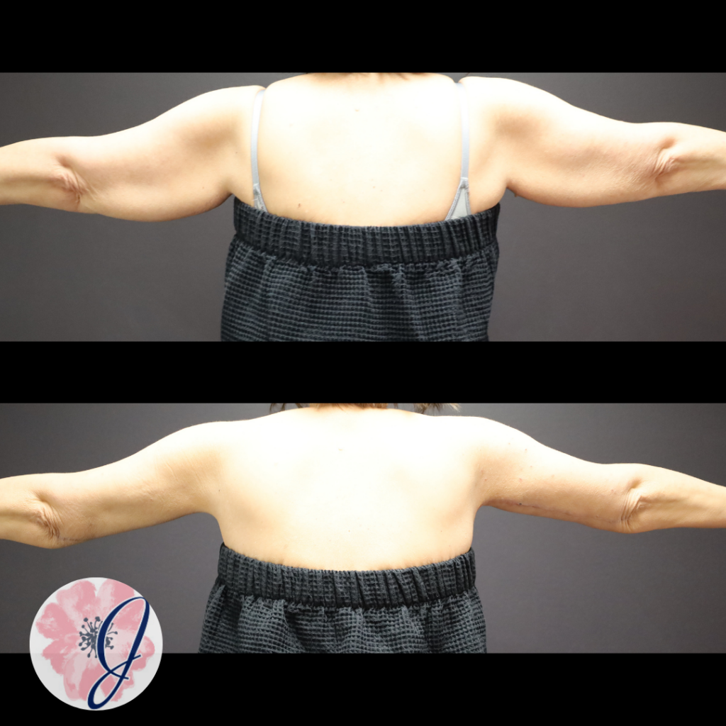 Brachioplasty + VASER liposuction to arms