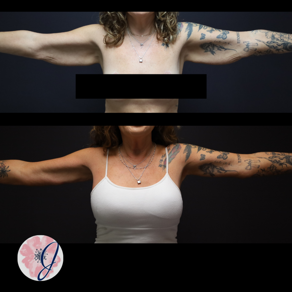 Brachioplasty + VASER Liposuction to the Arms
