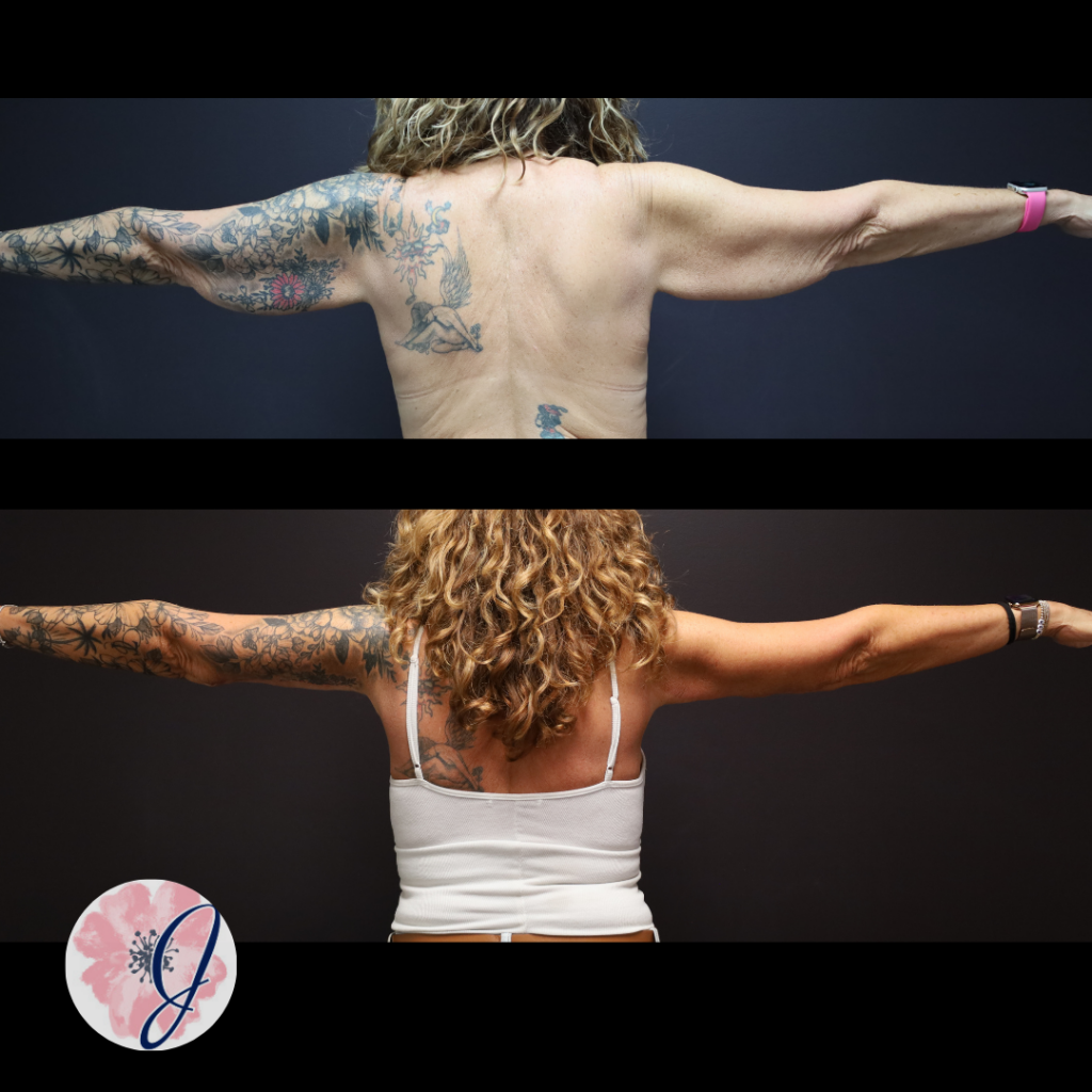 Brachioplasty + VASER Liposuction to the Arms