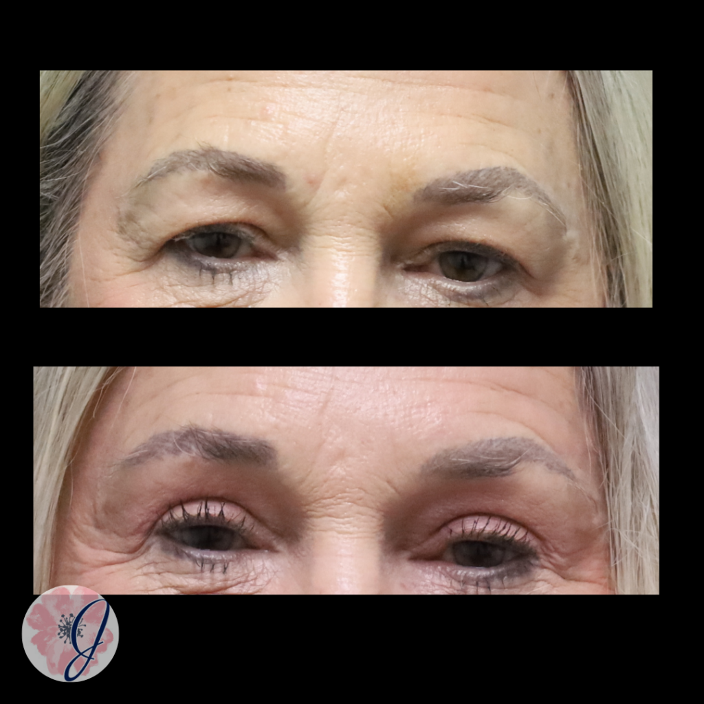 Endoscopic Brow Lift + Upper Blepharoplasty