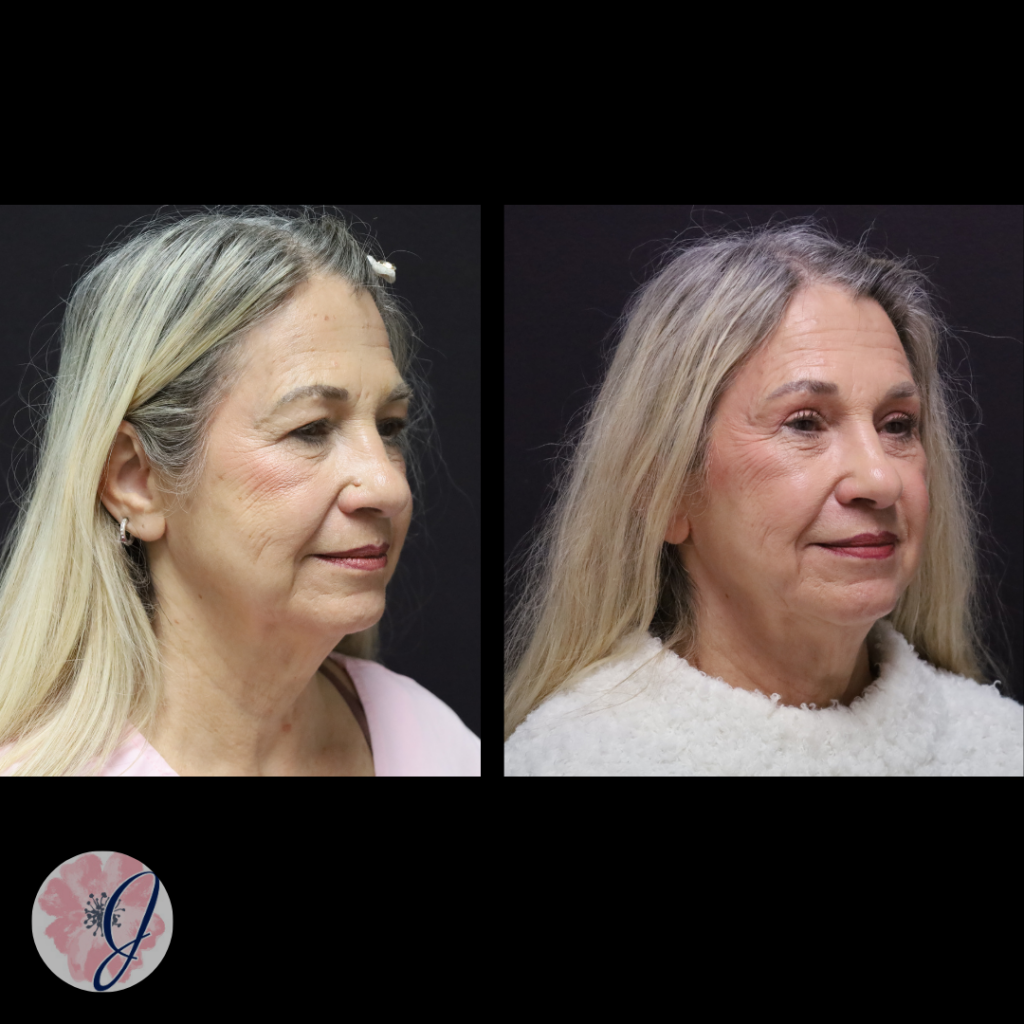 Endoscopic Brow Lift + Upper Blepharoplasty