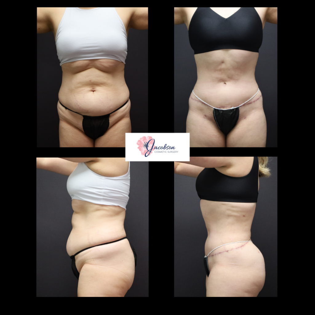 Extended Abdominoplasty (Tummy Tuck) + Liposuction 360
