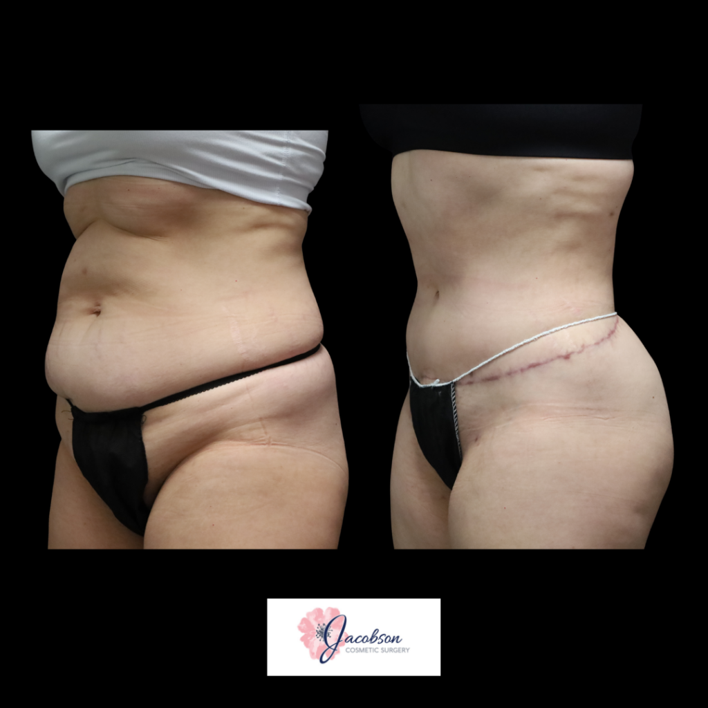 Extended Abdominoplasty (Tummy Tuck) + Liposuction 360