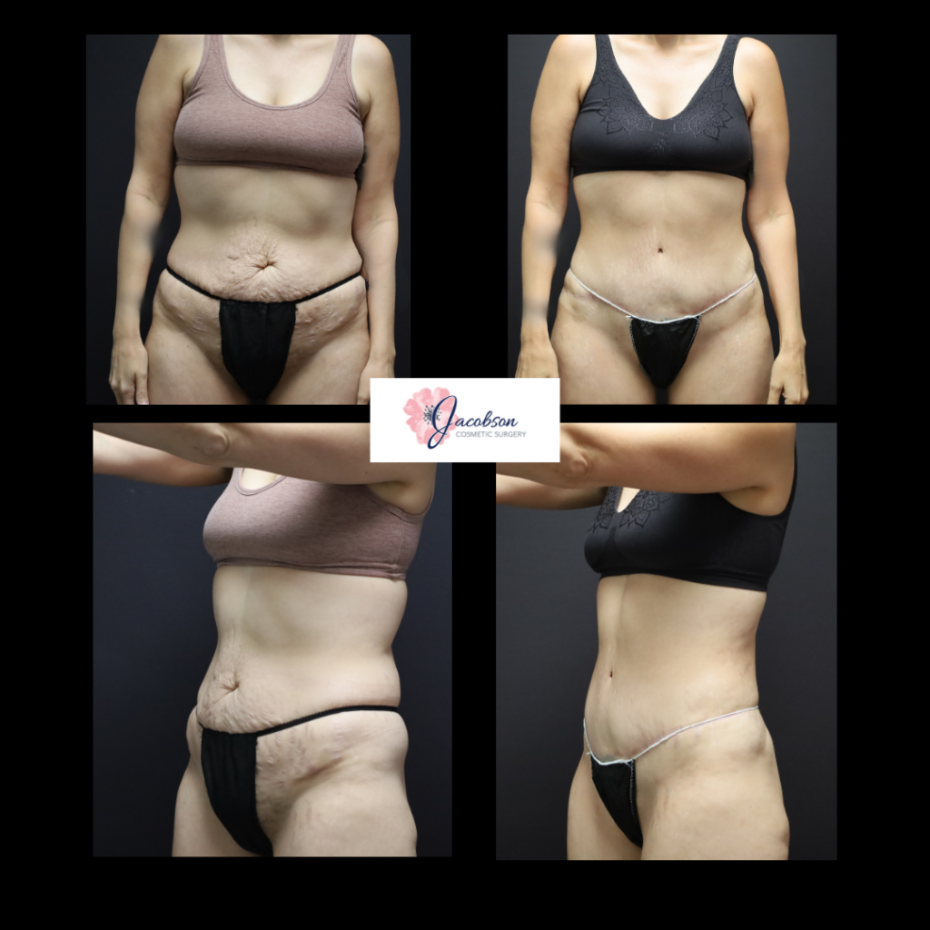 Abdominoplasty (Tummy Tuck) + Liposuction 360