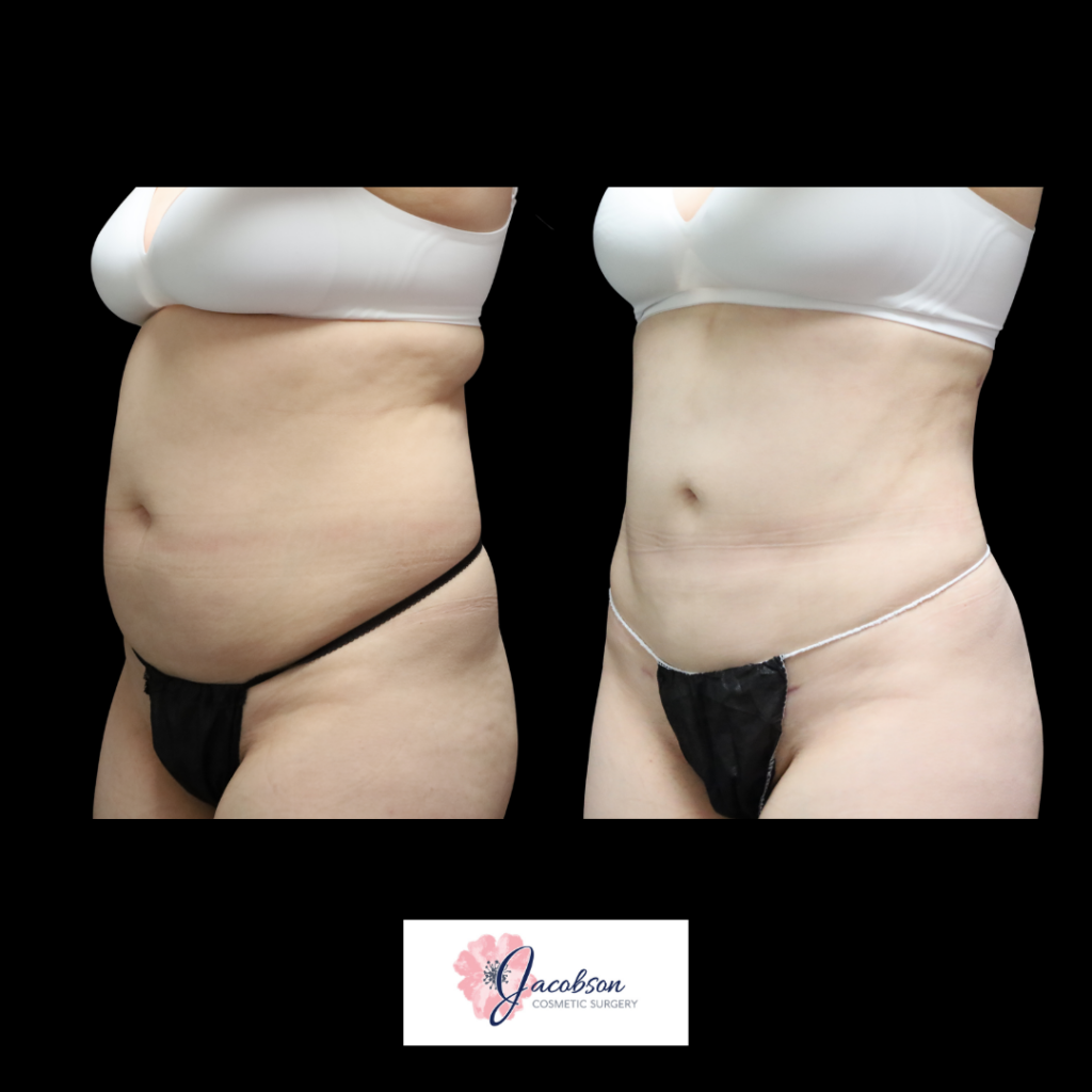 Liposuction 360: VASER Liposuction + Renuvion® to the Abdomen, Flanks, Back & Bra Roll