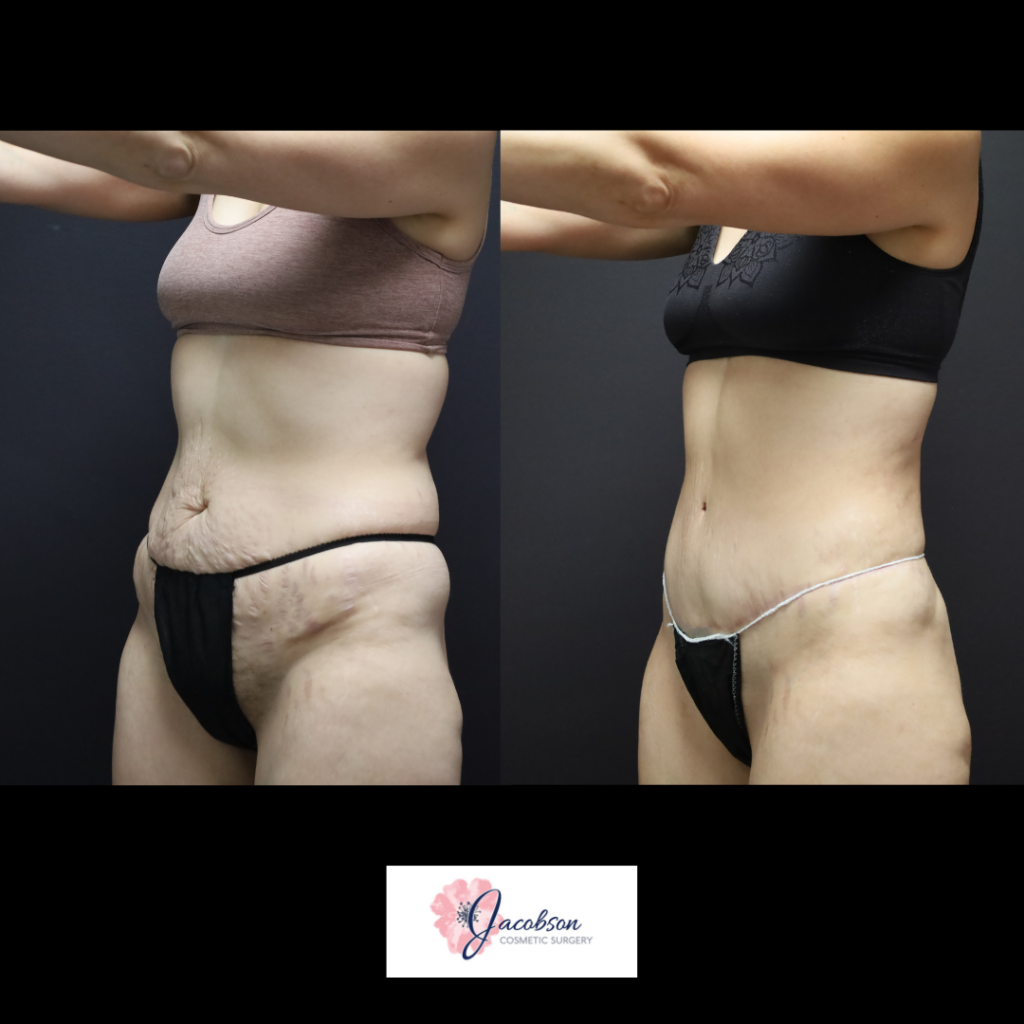 Abdominoplasty (Tummy Tuck) + Liposuction 360