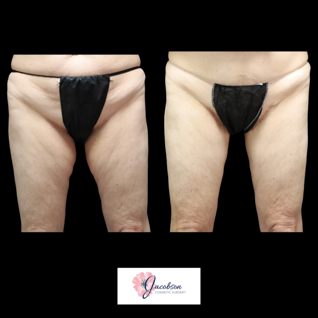 Medial Thigh Lift + VASER Liposuction Inner Thighs