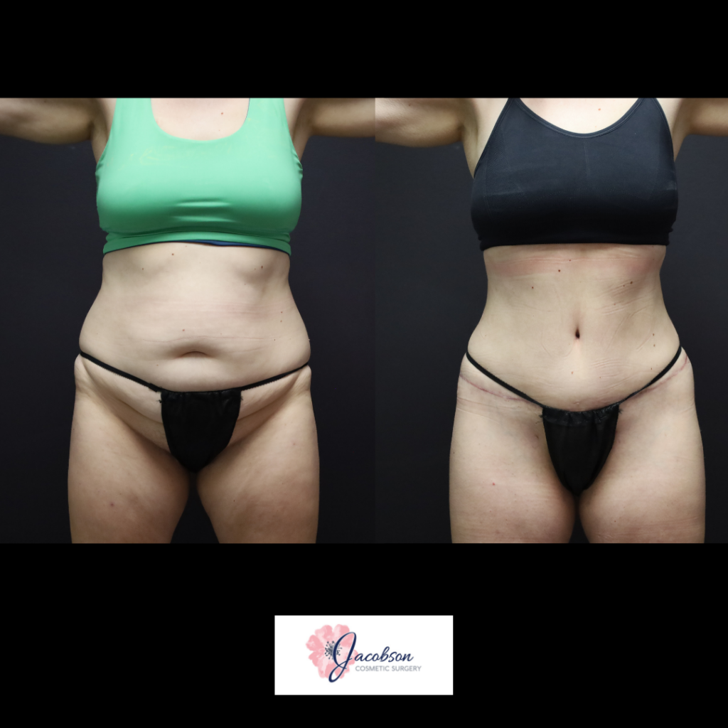 Abdominoplasty (Tummy Tuck) + Liposuction 360