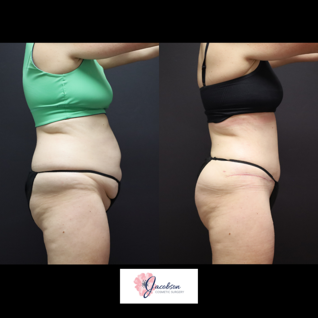 Abdominoplasty (Tummy Tuck) + Liposuction 360
