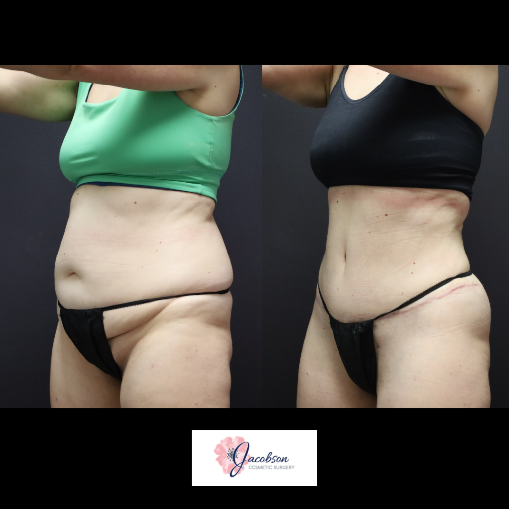 Abdominoplasty (Tummy Tuck) + Liposuction 360
