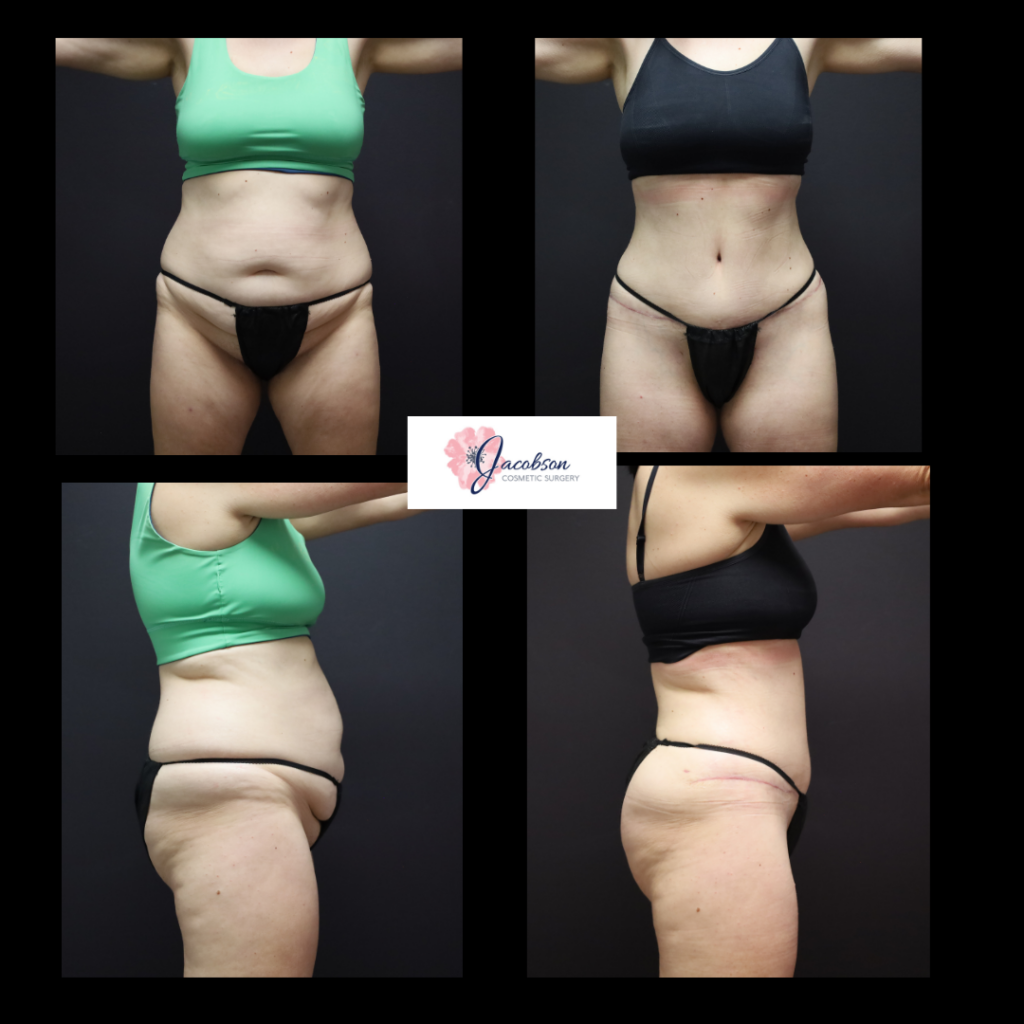 Abdominoplasty (Tummy Tuck) + Liposuction 360