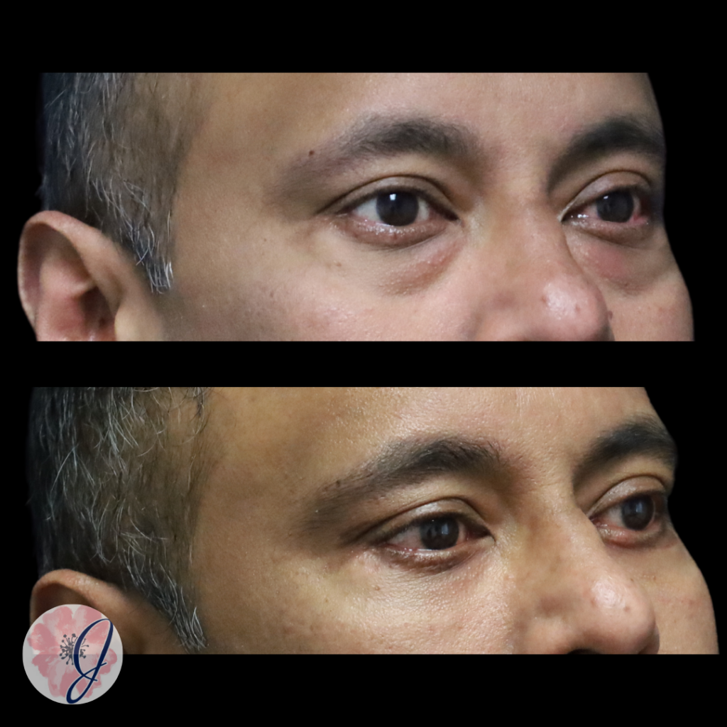 Lower Blepharoplasty (Transconjunctival) + Fat Transfer