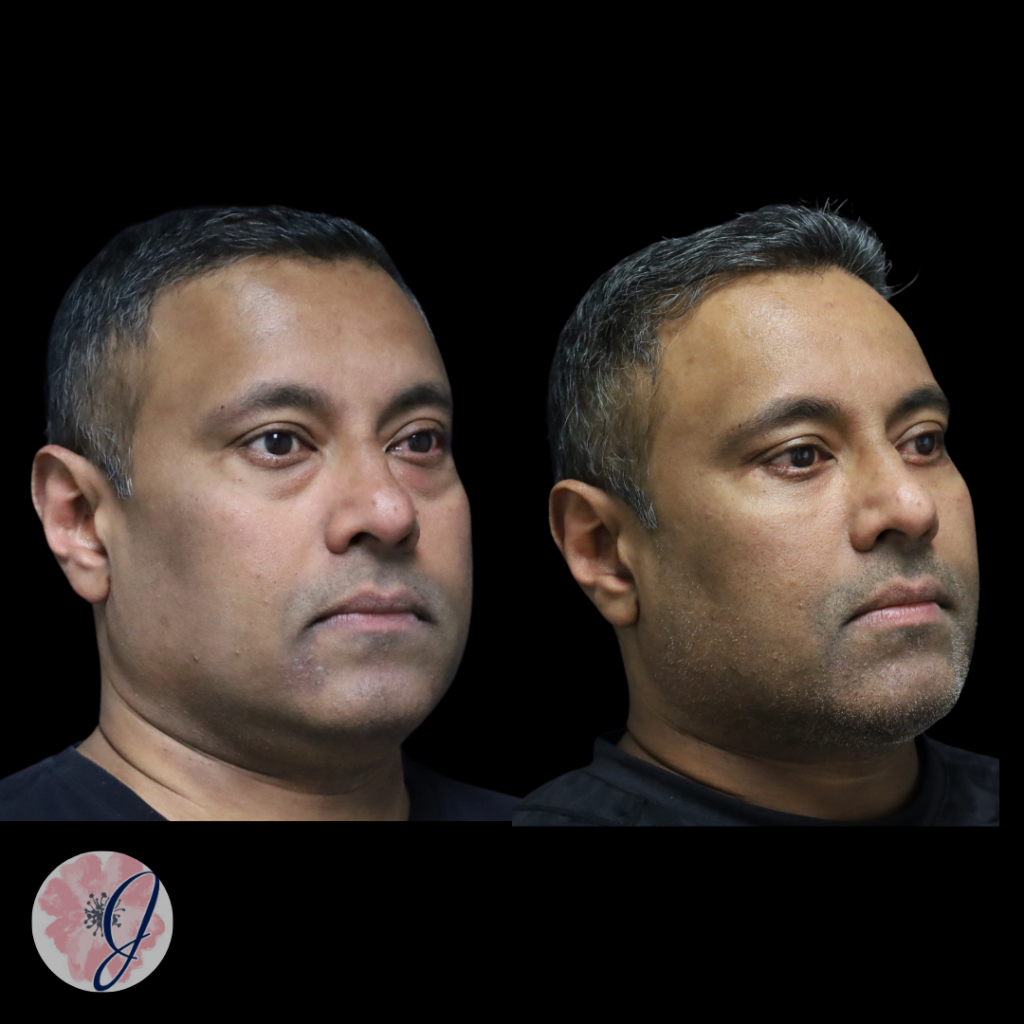 Lower Blepharoplasty (Transconjunctival) + Fat Transfer