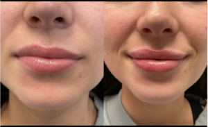 1mL Volbella To Lips