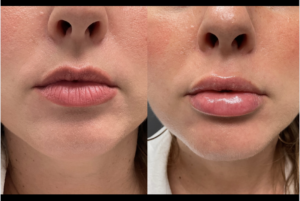 1mL Volbella To Lips