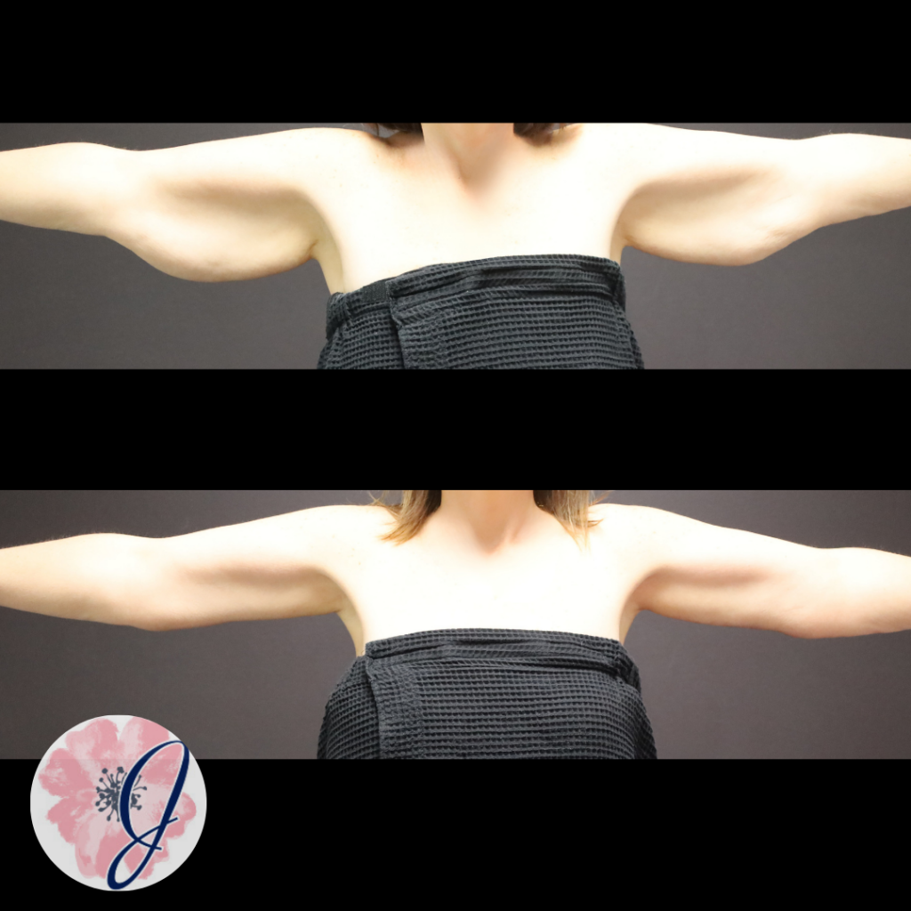 Brachioplasty + VASER Liposuction to the Arms