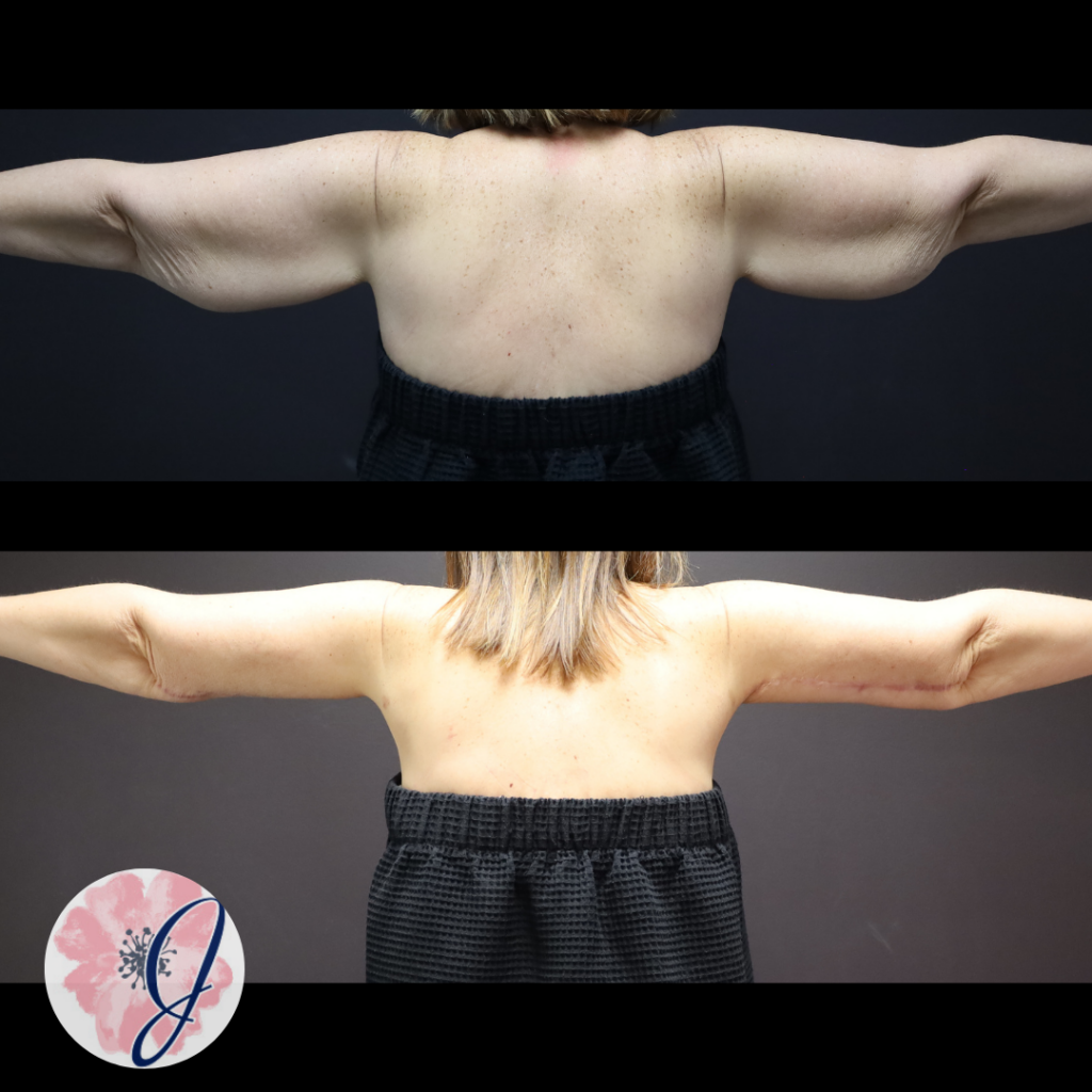 Brachioplasty + VASER Liposuction to the Arms