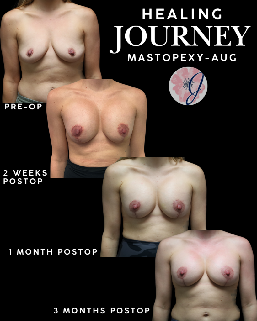 Breast Augmentation + Vertical Mastopexy